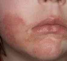 Léčba seboroické dermatitidy na obličeji