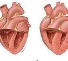 Plicní onemocnění srdce: příčiny, příznaky, léčba