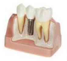 Metody zubní implantáty