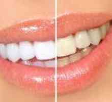 Je možné vybělit zuby doma? Mezi nejoblíbenější způsoby