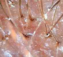 Nejúčinnější způsoby léčení seboroické dermatitidy skalpu