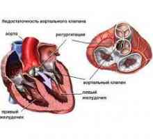 Aortální nedostatečnost ventil