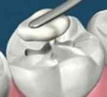 Neobvyklé materiály pro těsnění budou bojovat zubní kaz