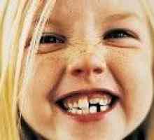 Malocclusion zubů