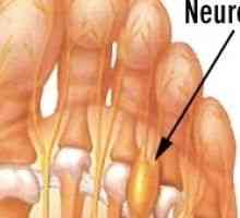 Mortona neurom (bolest nohou) - příčiny, příznaky a léčba