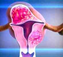 Chirurgické odstranění dělohy fibroids