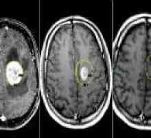 Nádor na mozku - příčiny, příznaky, léčba