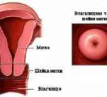 Děložního čípku ptóza, příznaky, léčba