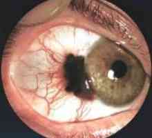 Diagnostika a léčení očního melanomu