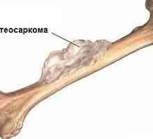 Osteosarkomu (osteogenní sarkom) - příčiny, příznaky, diagnostika a léčba