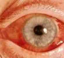 Glaukom s otevřeným úhlem: příznaky a léčba