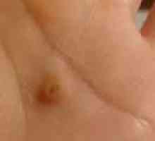 Ploché bradavice na obličeji a rukou: léčbu a odstranění