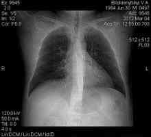 Plicní fibróza