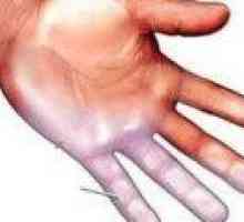 Proč necitlivé prsty pravé ruky jeho příčiny