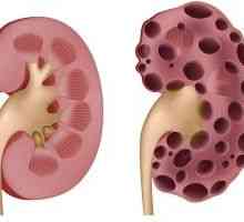 Polycystické onemocnění ledvin - příčiny, příznaky a léčba