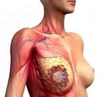 Příznaky rakoviny u žen hrudní kosti