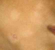 Jednoduché bílé kožního onemocnění: vlastnosti, způsoby léčby a prevence