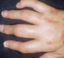 Psoriatická artritida