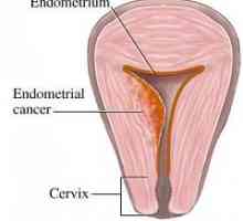 Rakoviny endometria