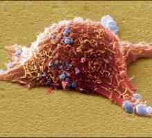 Rakovina kůže: Typy, příznaky, léčebné metody