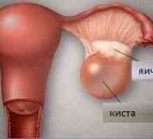Ruptura ovariální cysty - příčiny, příznaky, léčba