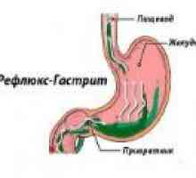 Reflux gastritida: příčiny, příznaky, léčba