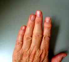 Revmatoidní artritida prstů, první příznaky