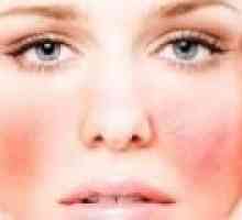 Příznaky a léčba alergií na obličej