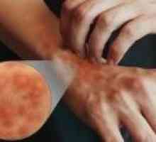 Příznaky a léčba atopické dermatitidy