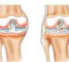 Příznaky a léčba ruptury menisku kolenního kloubu