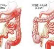 Symptomy ulcerózní kolitidy