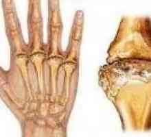 Symptomy revmatoidní artritidy