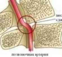 Syndrom páteřního tepny v oblasti krční osteochondróze