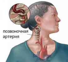 Syndrom páteřního tepny v oblasti krční osteochondróze: příznaky, prevence