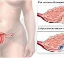 Fázi rakoviny vaječníků u žen