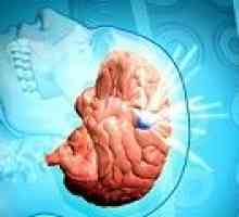 Subdurální hematom mozku: Příčiny, příznaky, léčba