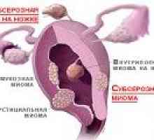 Subserous děložní myomy - příčiny, příznaky, léčba