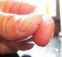 Popraskané kůže na rukou - příčiny, léčba