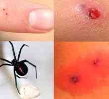 Pavoučí kousnutí - příznaky, léčba