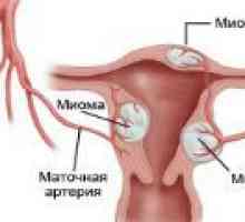 Tvárné děložní myomy - příčiny, příznaky, léčba