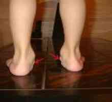 Valgus ploché nohy u dětí: Příčiny a léčba