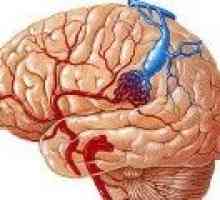 Žilní angiom mozku (cerebellum, čelní lalok)