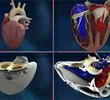 Francouzská první implantováno umělé srdce
