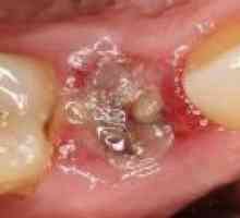 Zánět po extrakci zubu, léčbě antibiotiky
