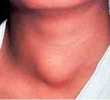 Zánět štítné žlázy (thyroiditida): příznaky a léčba