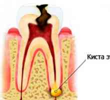 Je možné léčit zubní cysty, bez demontáže