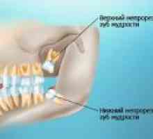 Možné následky při řezání a odstraňování zubů moudrosti