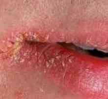 Perleches koutky úst: symptomy, příčiny, léčba