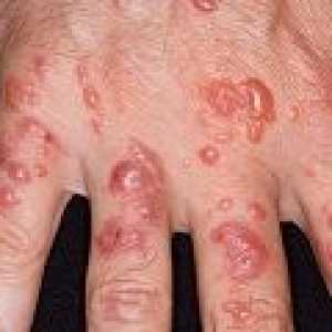 Aktinická dermatitida: příčiny, příznaky, léčba