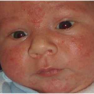 Alergická vyrážka u dětí